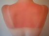 Rücken mit Sonnenbrand