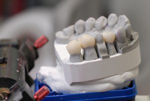 Zahnersatz mit Langzeithalt - Das können Implantate