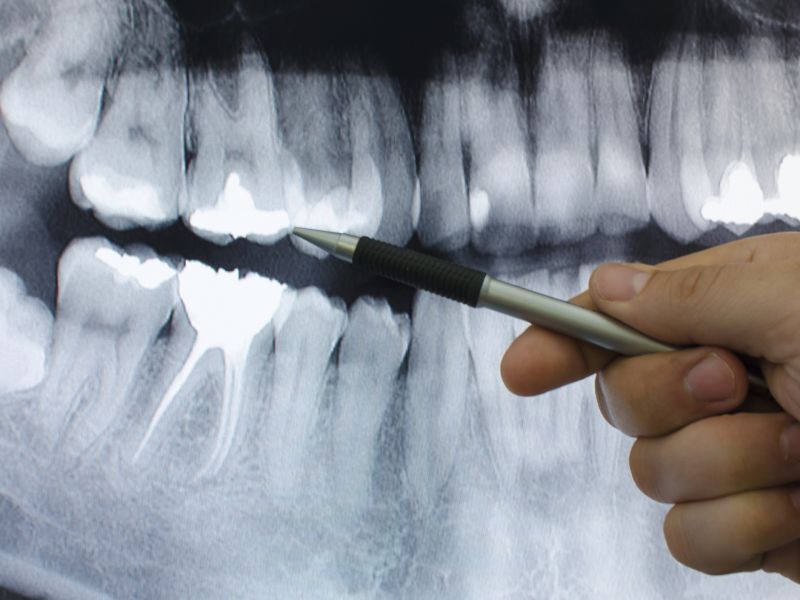 Komplette Zahnsanierung – Wichtige Infos und Tipps